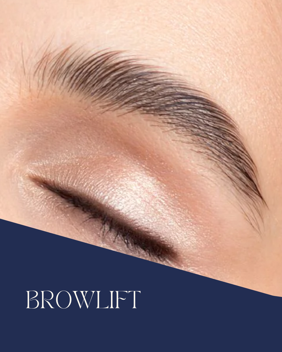 Browlift